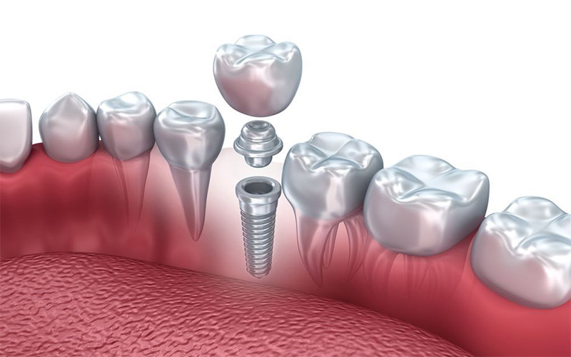 ایمپلنت دندان شامل سه بخش است. اباتمنت روکش را به پایه فلزی وصل کرده و ثابت روی فک باقی می‌ماند. 