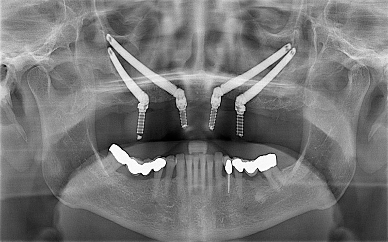 Cấy ghép Zygoma được đặt trong xương má và do đó không cần ghép xương.