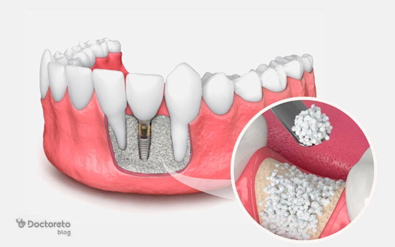 پیوند استخوان در ایمپلنت دندان، مزایا و معایب آن