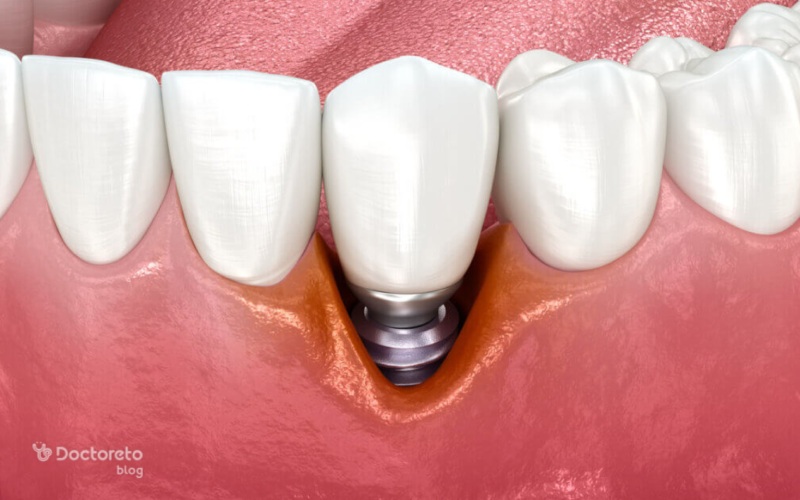 علت عفونت ایمپلنت دندان چیست و چگونه درمان می شود؟
