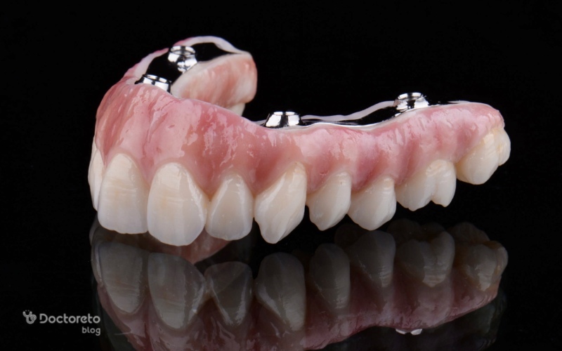 اوردنچر ایمپلنت، بهترین جایگزین برای کل دندان ها