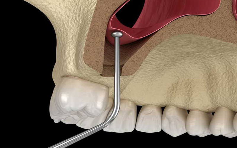 Trong phương pháp phẫu thuật này, khoảng trống phía trên xương hàm được lấp đầy bằng vật liệu xương. 