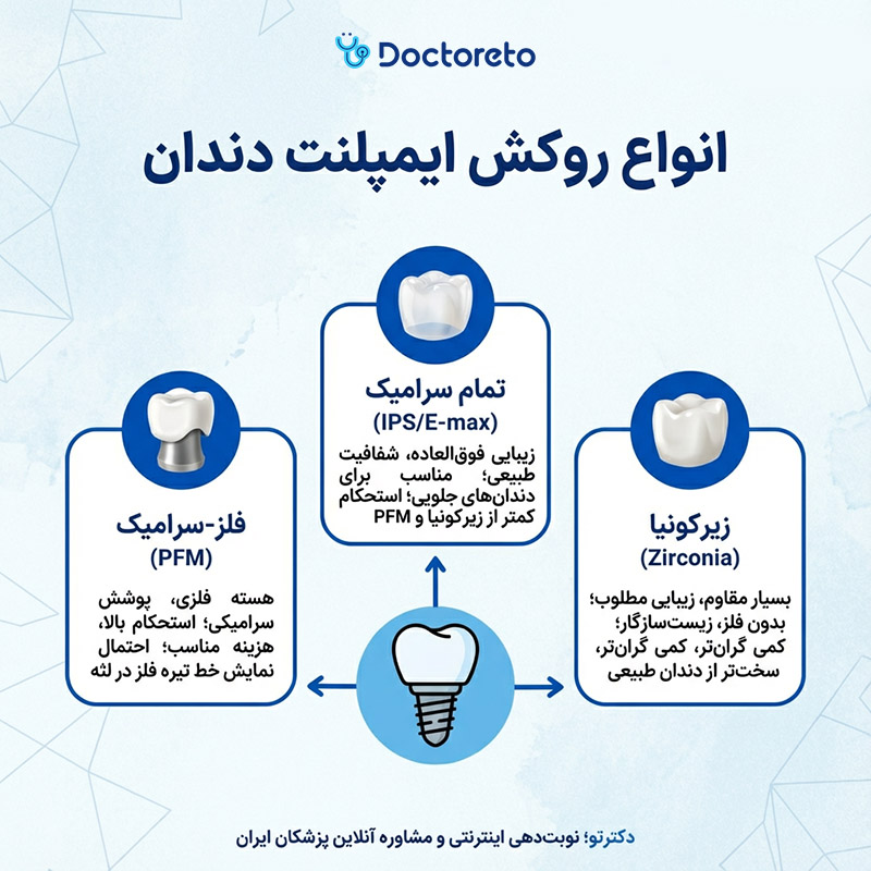 اینفوگرافی انواع روکش ایمپلنت دندان