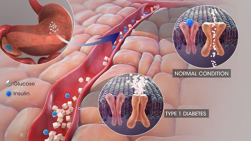 در دیابت تایپ ۱ چه اتفاقی می افتد