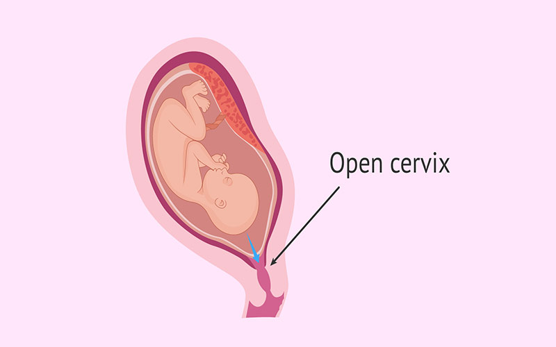 با باز شدن دهانه رحم در سه ماهه دوم بارداری احتمال زایمان زودرس افزایش پیدا می‌کند.