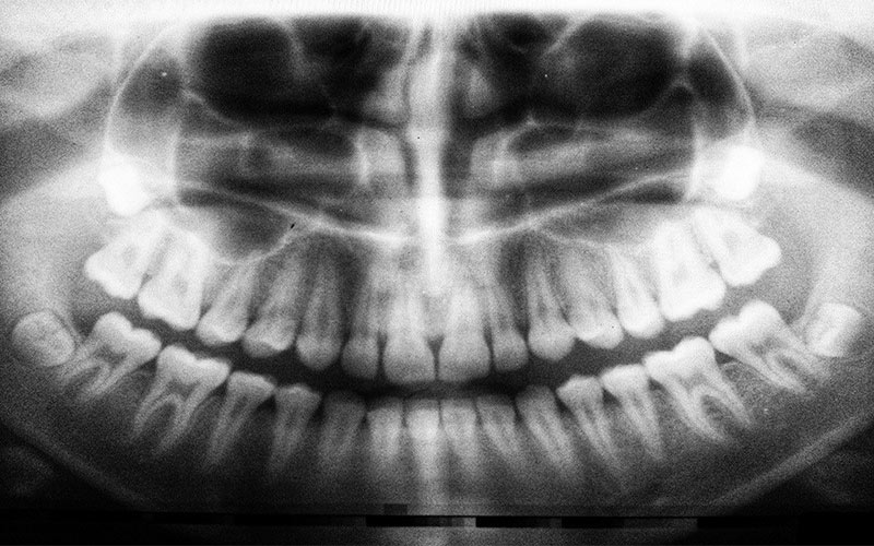 برای انجام معاینات اولیه ابتدا دندانپزشک عکسبرداری با اشعه ایکس را تجویز می‌کند. 