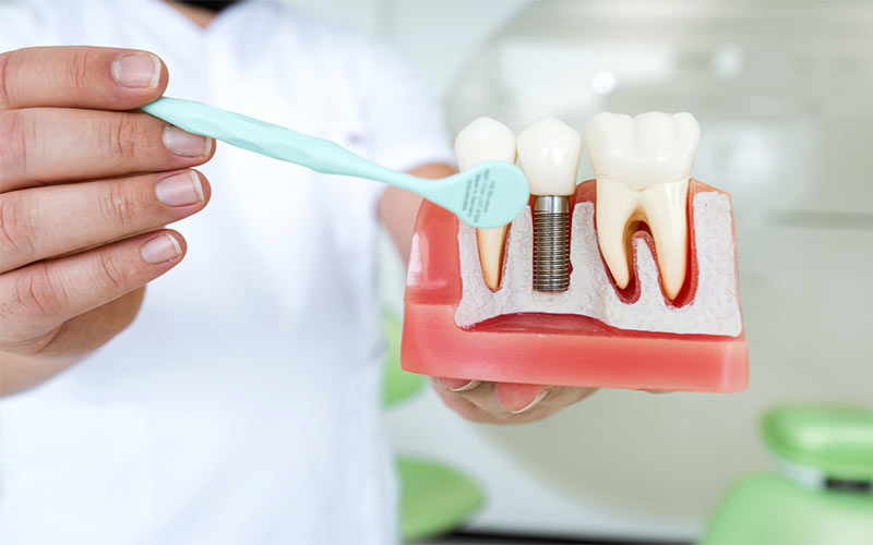 ایمپلنت های دندانی به طور متوسط ​​25 سال دوام می آورند. 