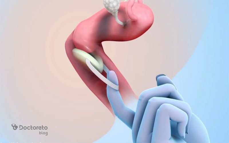 چگونه اسفنج ضد بارداری را خارج کنیم؟