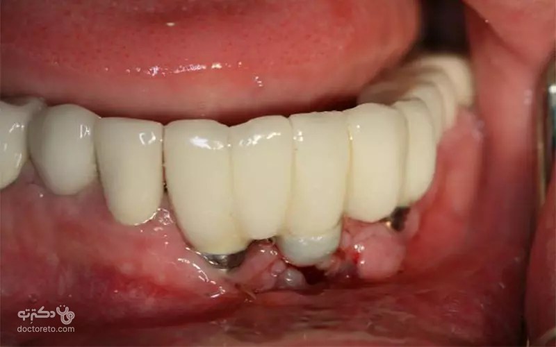 bone-resorption-after-dental-implants-1.jpg