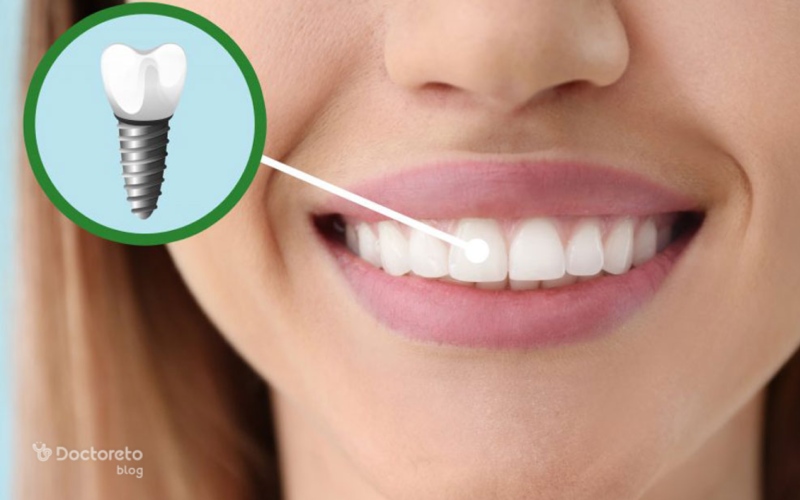 عمر ایمپلنت دندان به چه عواملی بستگی دارد؟