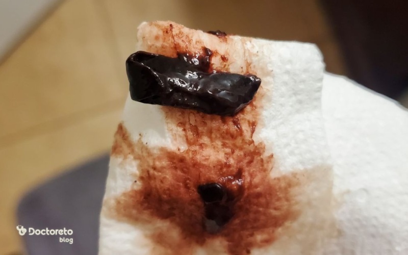 عکس دفع لخته هماتوم بارداری