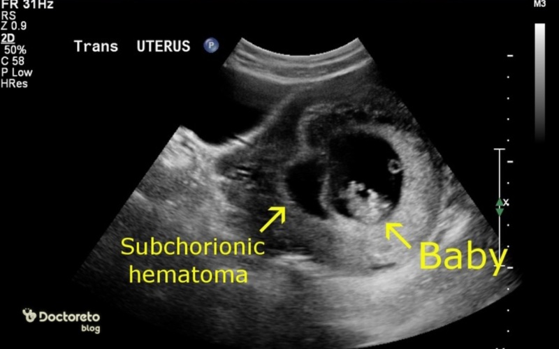 عکس سونوگرافی هماتوم در بارداری