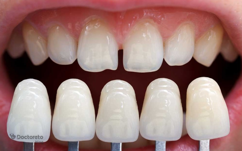 زیبایی دندان بدون تراش دهان را بدبو میکند؟