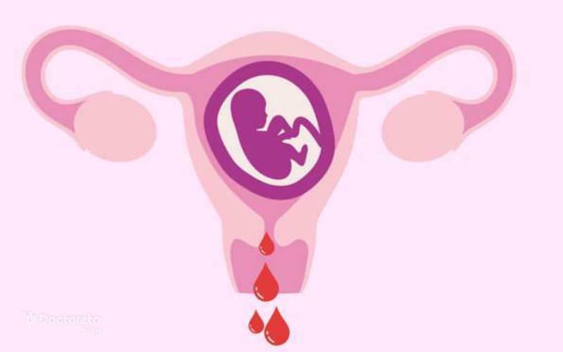 هماتوم بارداری، یکی از علل شایع خونریزی در دوره حاملگی