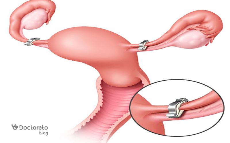 عوارض بستن لوله رحم در زنان چیست؟