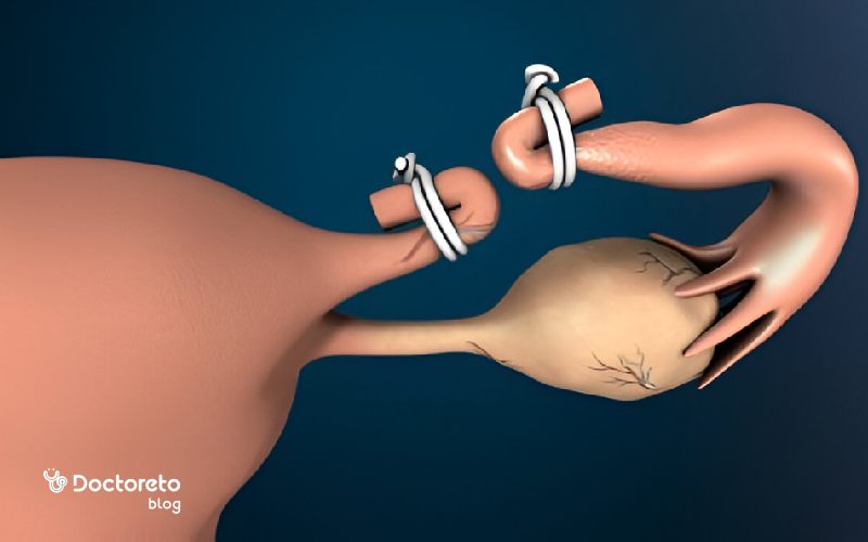 عکس از بستن لوله رحم