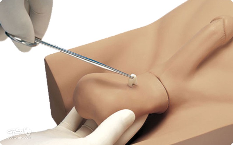 عوارض شایع عمل جراحی بستن لوله مردان چیست؟