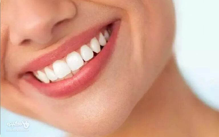 لمینت کامپوزیتی روشی برای زیبایی لبخند