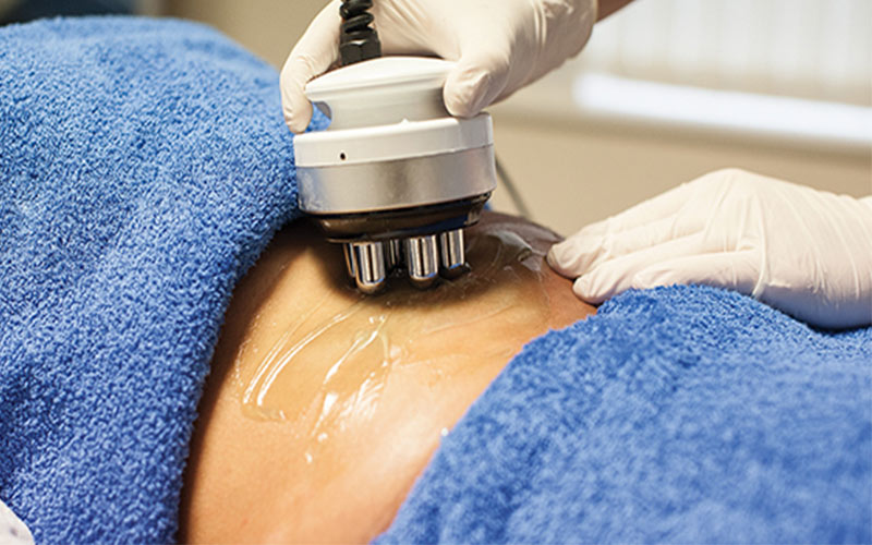 Trong phương pháp RF, tần số vô tuyến sẽ loại bỏ lớp mỡ cứng dưới da.
