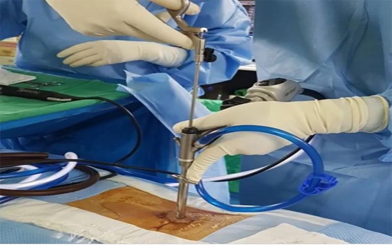 جراح می‌تواند برای کاهش فشار روی ریشه عصبی مقداری از دیسک را بردارد.