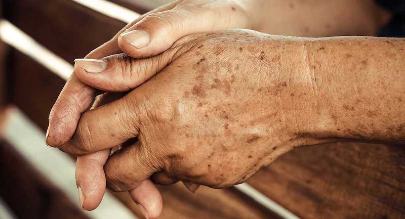 عکس بیماری پوستی لکه های کبدی در افراد مسن