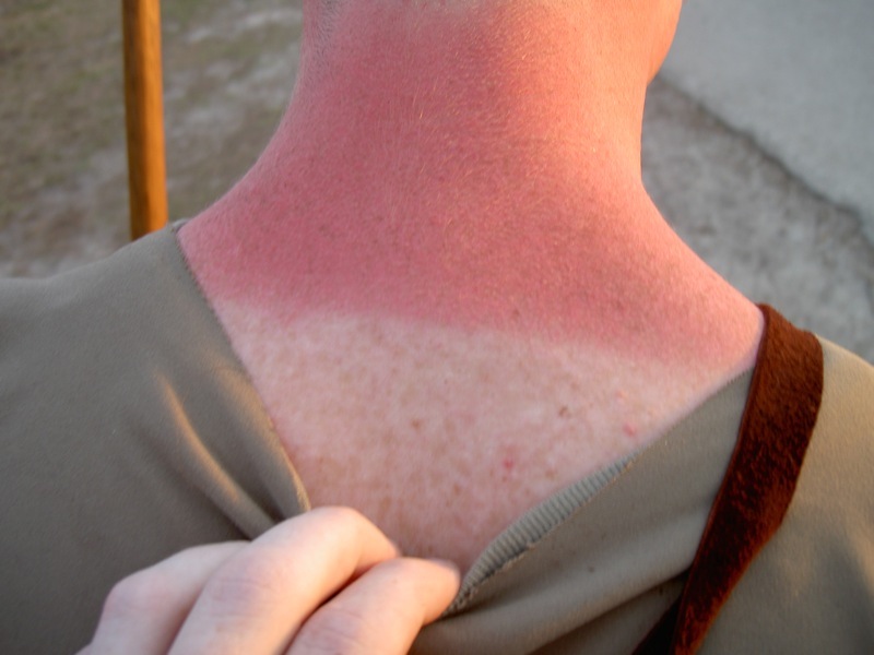 عکس بیماری های پوستی ناشی از آفتاب