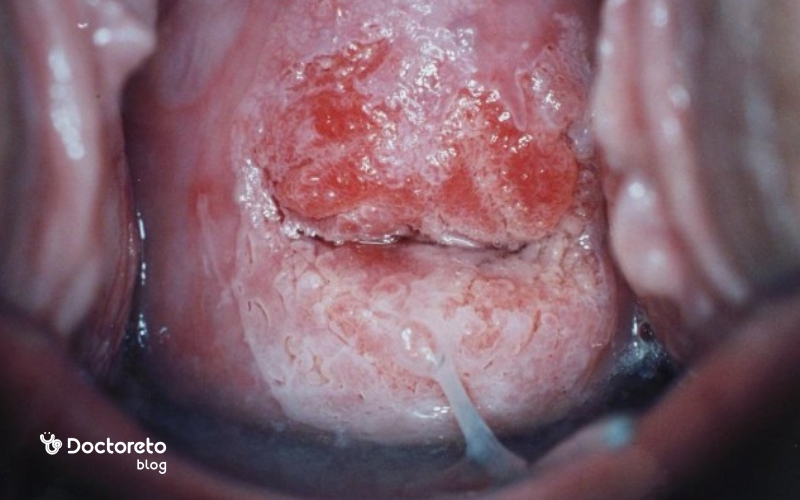 عکس دیسپلازی دهانه رحم