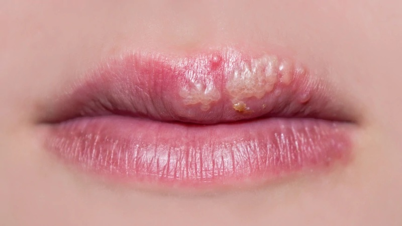 عکس بیماری های پوستی تبخال دهانی 