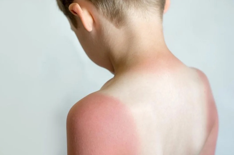 بیماری های پوستی مرتبط با آفتاب