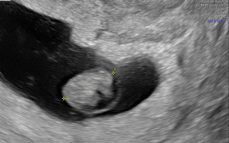 در این تصویر می‌توانید سونوگرافی هفته 7 بارداری را مشاهده کنید.