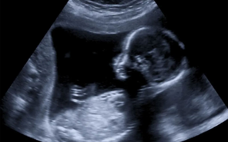در سونوگرافی هفته سیزدهم حاملگی حرکات جنین دیده می‌شود. اما هنوز برای تشخیص جنسیت زود است.