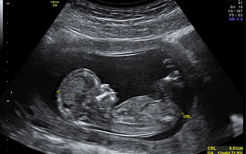 در هفته 15 بارداری هنوز اندام‌های تناسلی جنین در سونوگرافی دیده نمی‌شود.