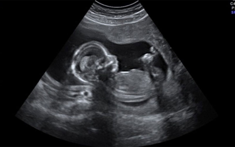 در سونوگرافی هفته شانزدهم حاملگی می‌توان ضربان قلب جنین را شنید و حرکات او را مشاهده کرد.