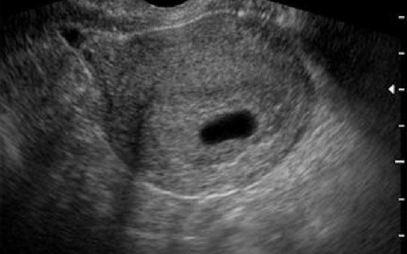 در هفته پنجم حاملگی جنین در سونوگرافی دیده نمی‌شود. اما همانطور که در تصویر می‌بینید کیسه حاملگی قابل مشاهده است. 