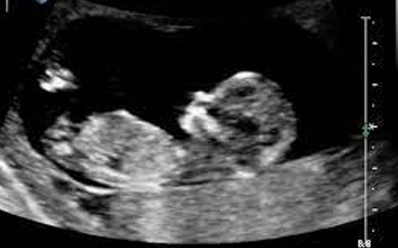 در سونوگرافی هفته نهم حاملگی جنین دیده شده و می‌توان ضربان قلب را شنید.