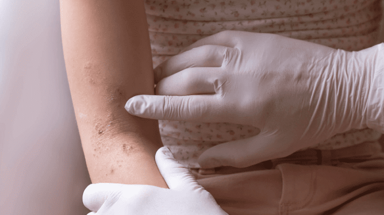 مولوسکوم کونتاژیوزوم یا زگیل آبکی چیست و چگونه درمان می شود؟