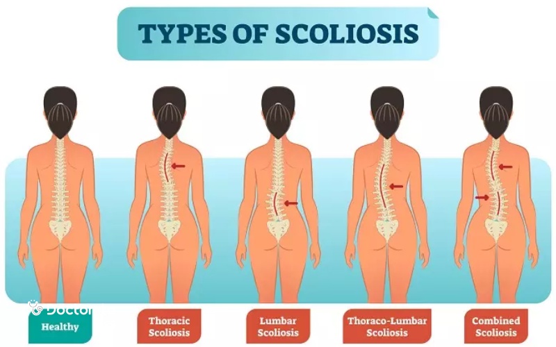 اسکولیوز چیست؟