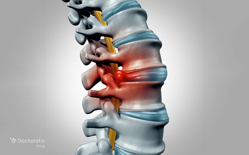 تنگی کانال نخاع چیست و چگونه درمان می شود؟