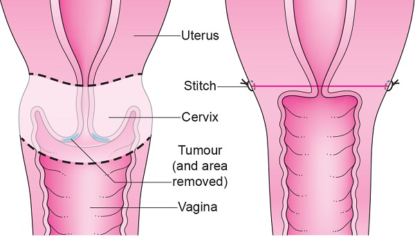 درمان سرطان واژن چیست؟