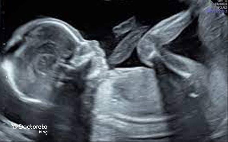 عکس جنین ۱۸ هفته در سونوگرافی