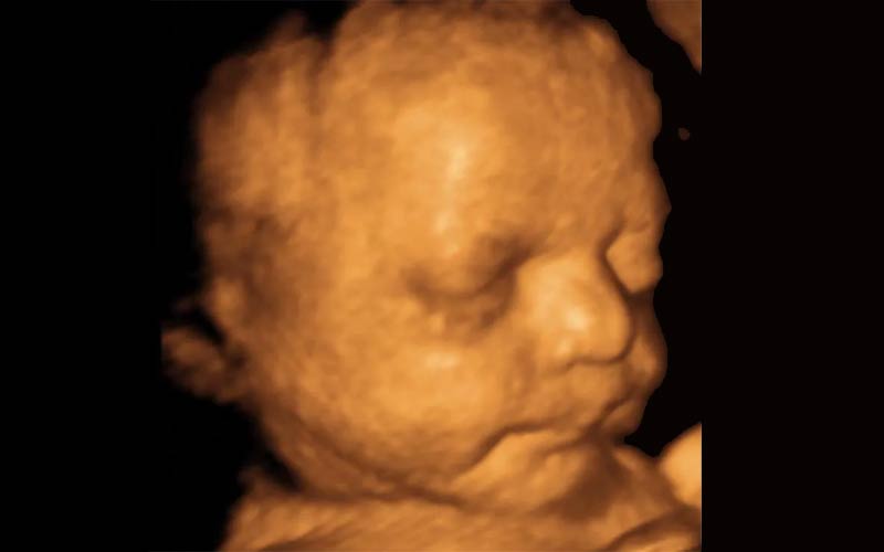  در این تصویر می‌توانید سونوگرافی سه بعدی جنین را در هفته ۳۳ بارداری مشاهده کنید.