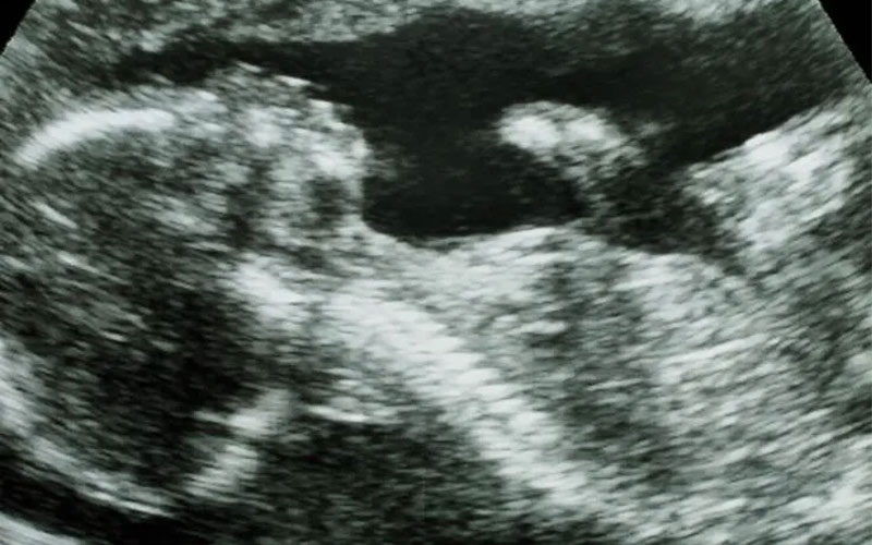 برای اکوکاردیوگرافی جنین باید سونوگرافی انجام شود و قسمت‌های مختلف قلب در تصویر مشخص شود.
