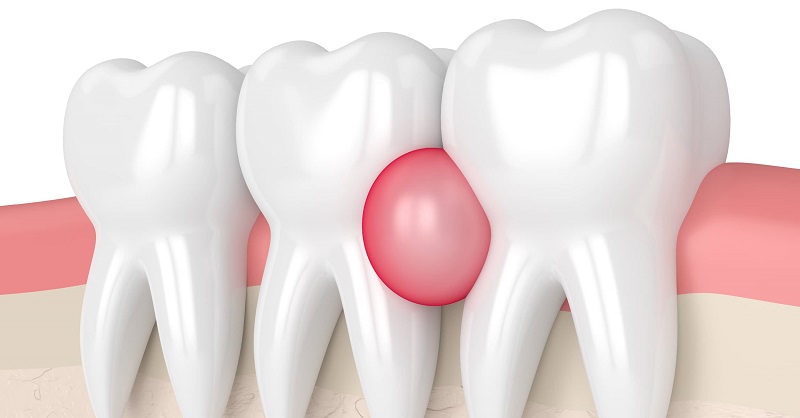 عوامل موثر در آبسه دندان