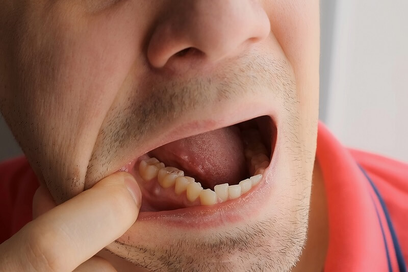 دلیل آبسه دندانی