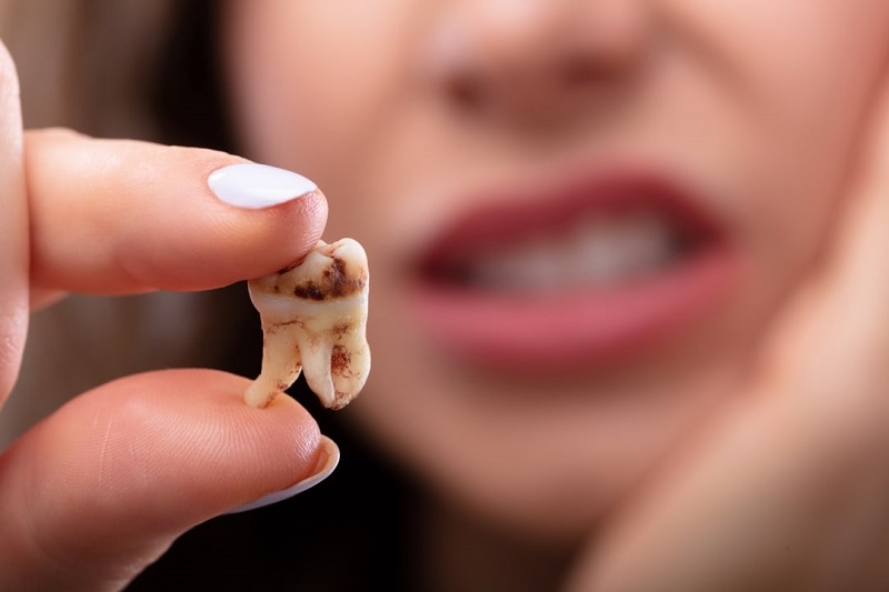 درباره پوسیدگی دندان بیشتر بدانید