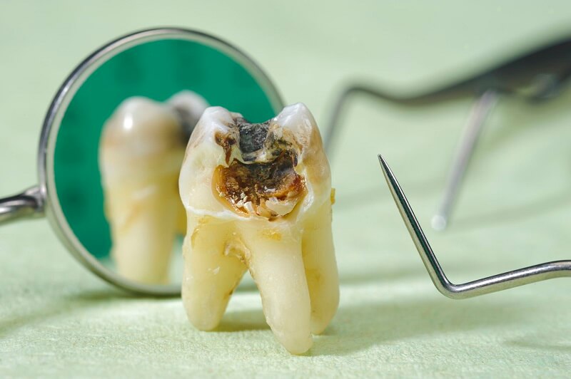 شدت پوسیدگی دندان