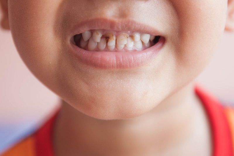 درمان دندان کودک