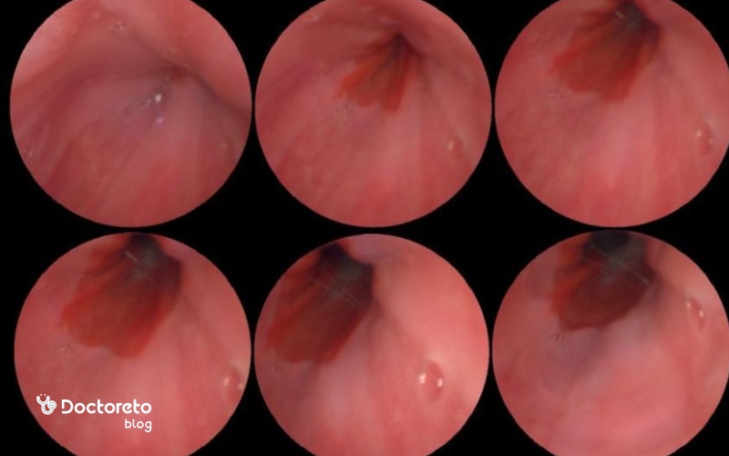 عکسهای سرطان واژن