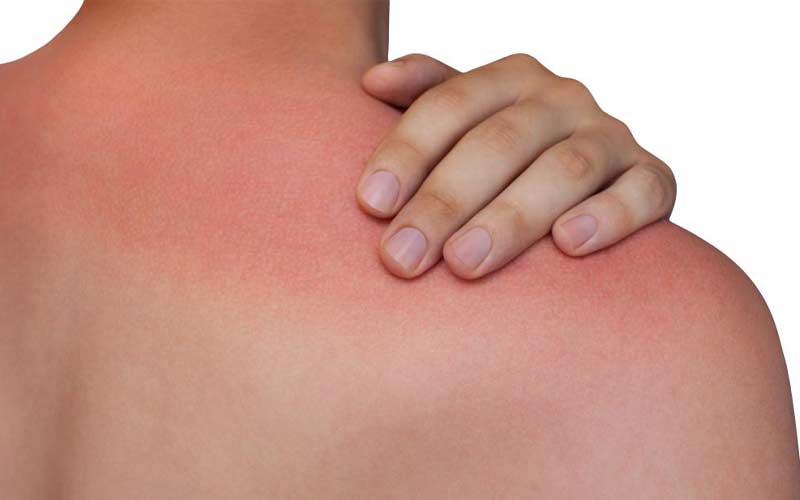 آفتاب‌سوختگی یکی از انواع سوختگی درجه ۱ است. ماندن زیر آفتاب در مدت زمان طولانی باعث سوختگی پوست می‌شود.