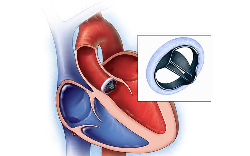 گاهی در عمل آئورت قلب نیاز به تعویض دریچه است. جراح ممکن است از دریچه مکانیکی استفاده کند.